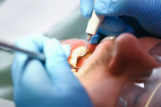 Best Emergency Root Canal Treatment in West Fork, AR